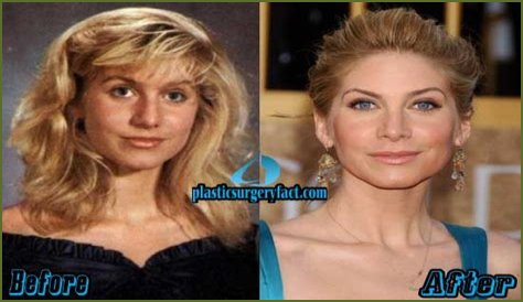 Elizabeth Mitchell Plastic Surgery Before and After
