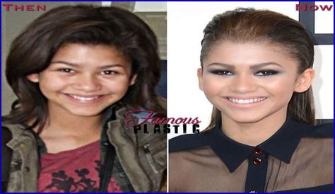 Unveiling The Secrets Of Zendaya's Nose Job: Discoveries And Insights
